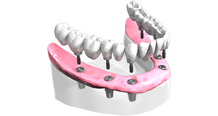 Implantologie dentaire Marseille - Cabinet dentaire Drs Damiani et Richelme - Dentiste Marseille