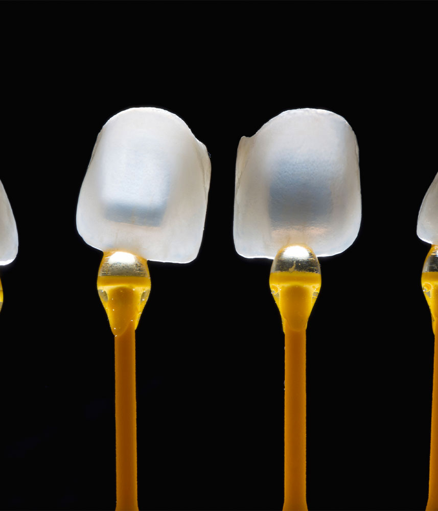 Facette dentaire - Cabinet dentaire Drs Damiani et Richelme - Dentiste Marseille
