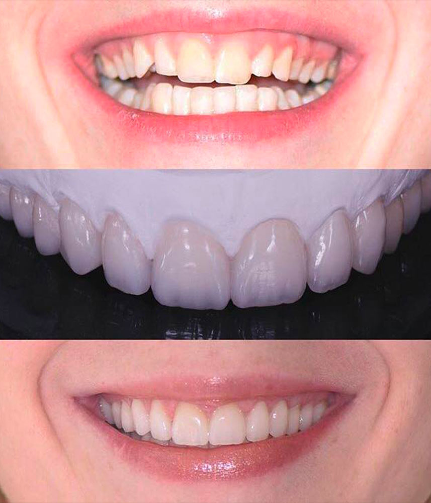 Facette dentaire Marseille - Cabinet dentaire Drs Damiani et Richelme - Dentiste Marseille