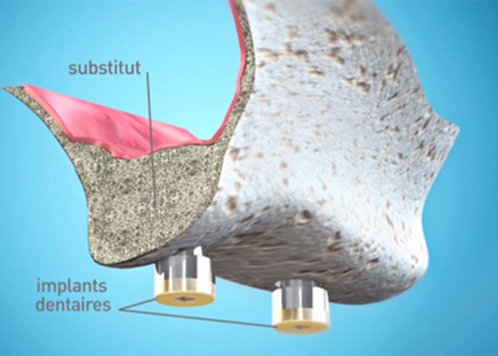 Greffe implantaire Marseille - Cabinet dentaire Drs Damiani et Richelme - Dentiste Marseille