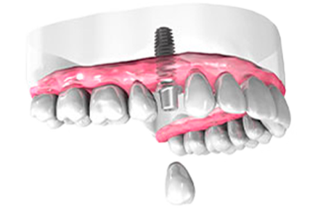 Implant dentaire Marseille - Cabinet dentaire Drs Damiani et Richelme - Dentiste Marseille