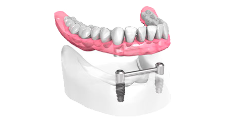 Prothèse dentaire Marseille - Cabinet dentaire Drs Damiani et Richelme - Dentiste Marseille