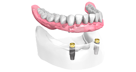 Prothèse dentaire - Cabinet dentaire Drs Damiani et Richelme - Dentiste Marseille