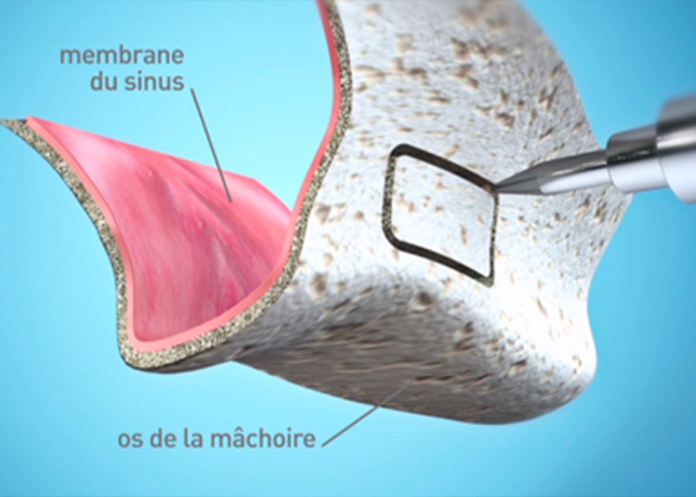 Sinus Lift Marseille - Cabinet dentaire Drs Damiani et Richelme - Dentiste Marseille