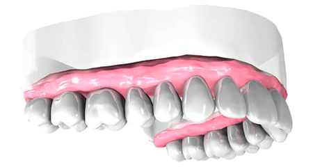 Remplacement de dents - Cabinet dentaire Drs Damiani et Richelme - Dentiste Marseille